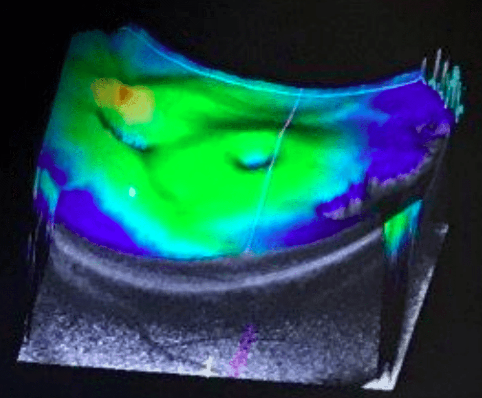 AI-assisted OCT scan analysis showing cross-sectional retinal layers with normal thickness and healthy eye structure - OccuScan AI optometry software